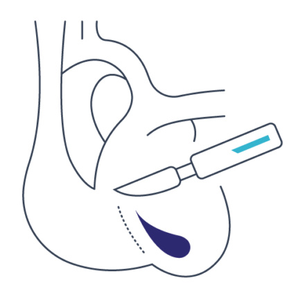 Chirurgia onkologiczna Lublin, Grupa Scanmed, piktogram przedstawiający skalpel