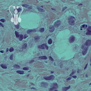 biopsja prostaty Lublin, Gastromed Lublin, komórki rakowe