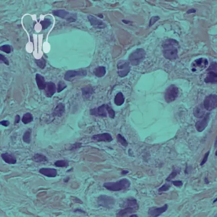 Biopsja prostaty Lublin, Gastromed Lublin, Scanmed, na zdjęciu komórki rakowe